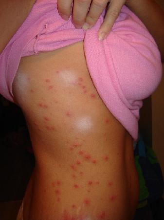 Common Bacterial Skin Infections - American Family Physician